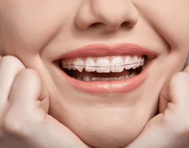 Durchsichtige Zahnspange – Keramik Zahnspange für Jugendliche