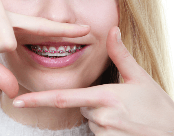 Jugendliche mit Zahnspange in kieferorthopädischer Behandlung