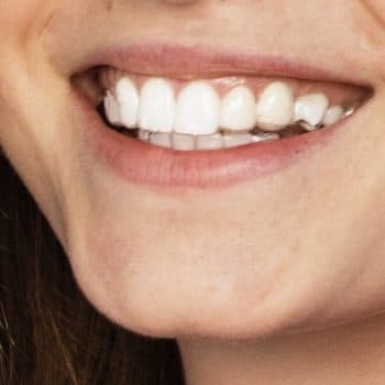 Durchsichtige Aligner-Schienen