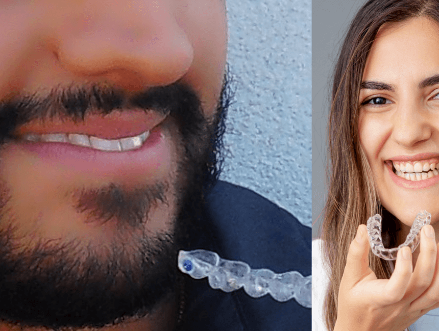 Ästhetische festsitzende Zahnspange (Beispielabbildung)