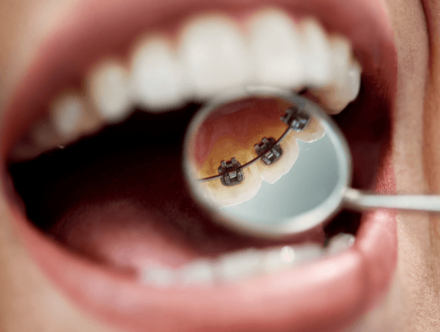 Lingualtechnik Zahnspange – innenliegende Zahnspange