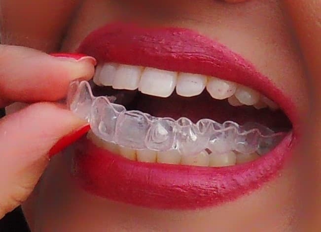 Erwachsene Patientin mit Invisalign Clear Alignern