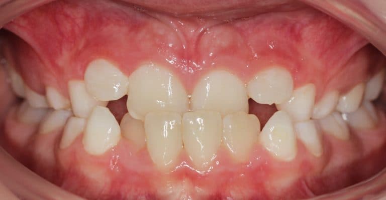 Lateraler Kreuzbiss und Rücklage Oberkiefer