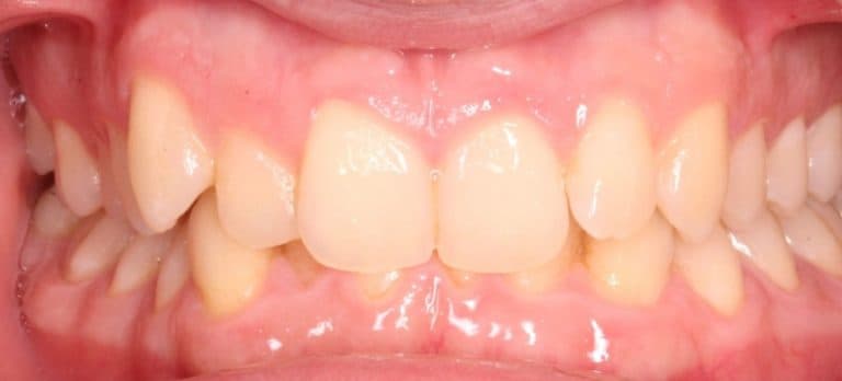 Traumatischer Tiefbiss / Überbiss bei Kindern