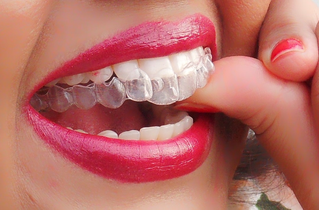 Braces
