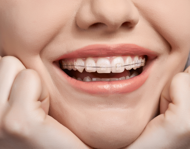 Clear ceramic braces