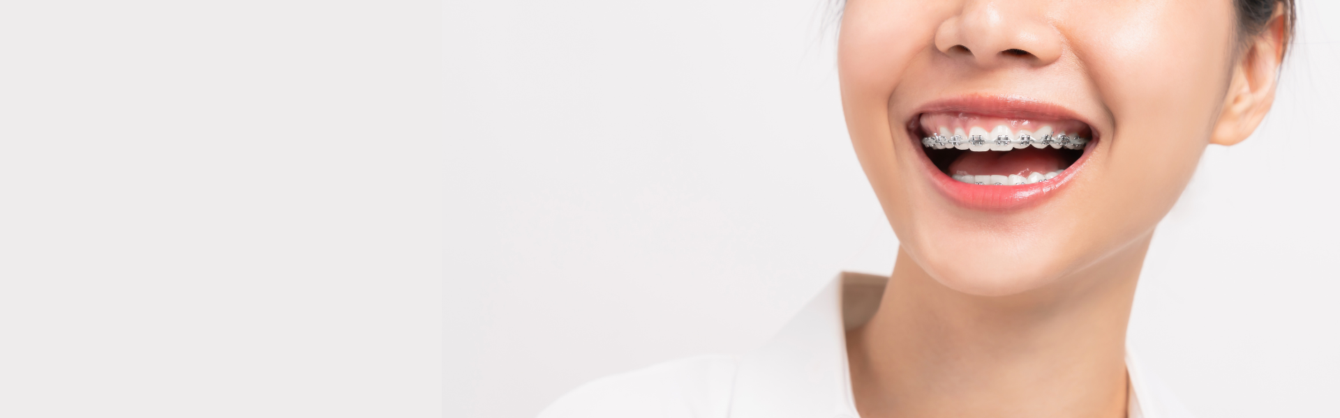 Metal brackets – publicly funded braces