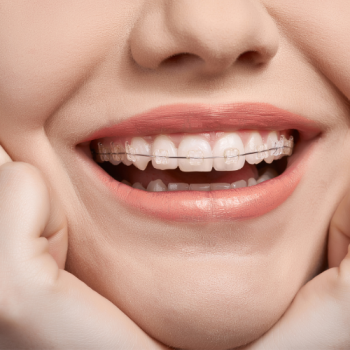Fixed metal braces
