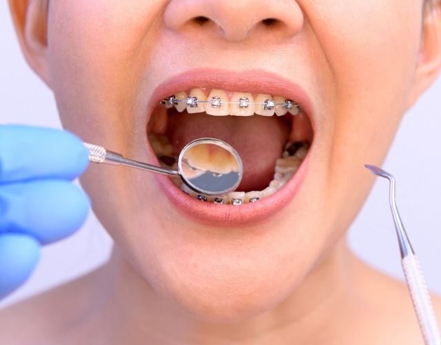 Orthodontic instruments
