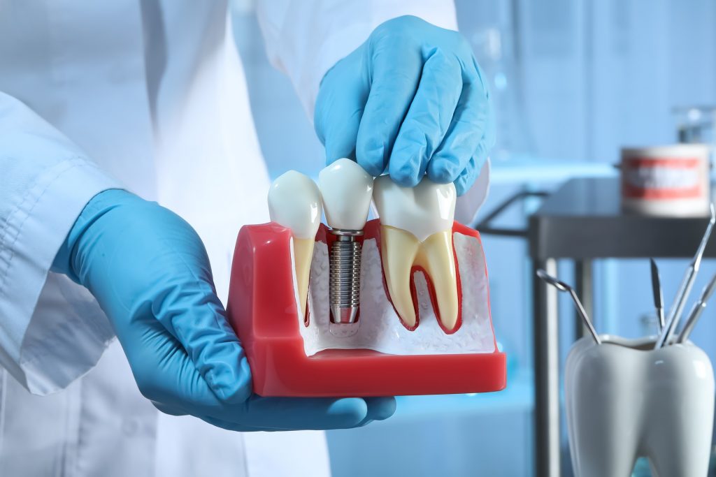 Zahn Implant