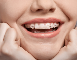 Ceramic brackets with a slim metal archwire