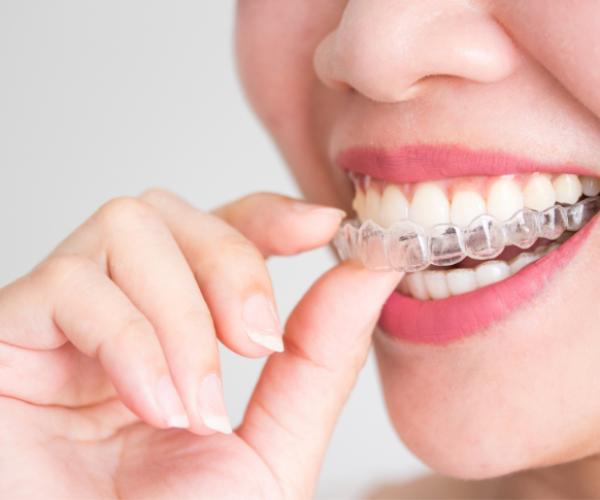 Unsichtbare Zahnspange Wien - Invisalign Wien Clear Aligners Zahnspange für Erwachsene | Clear Aligners