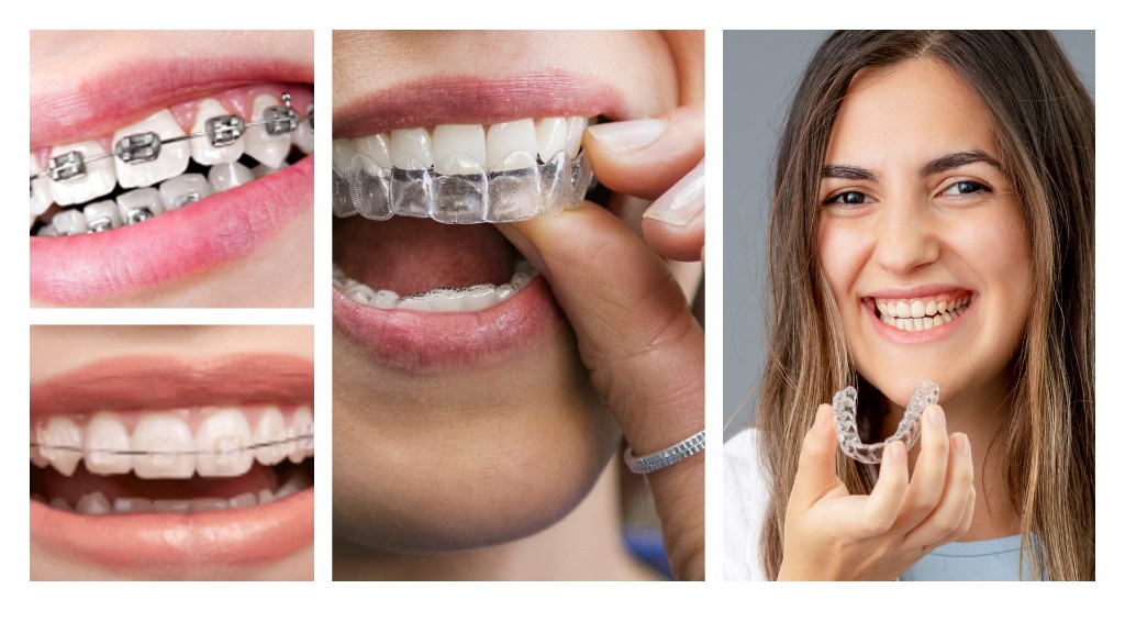 Overview of different orthodontic treatment options