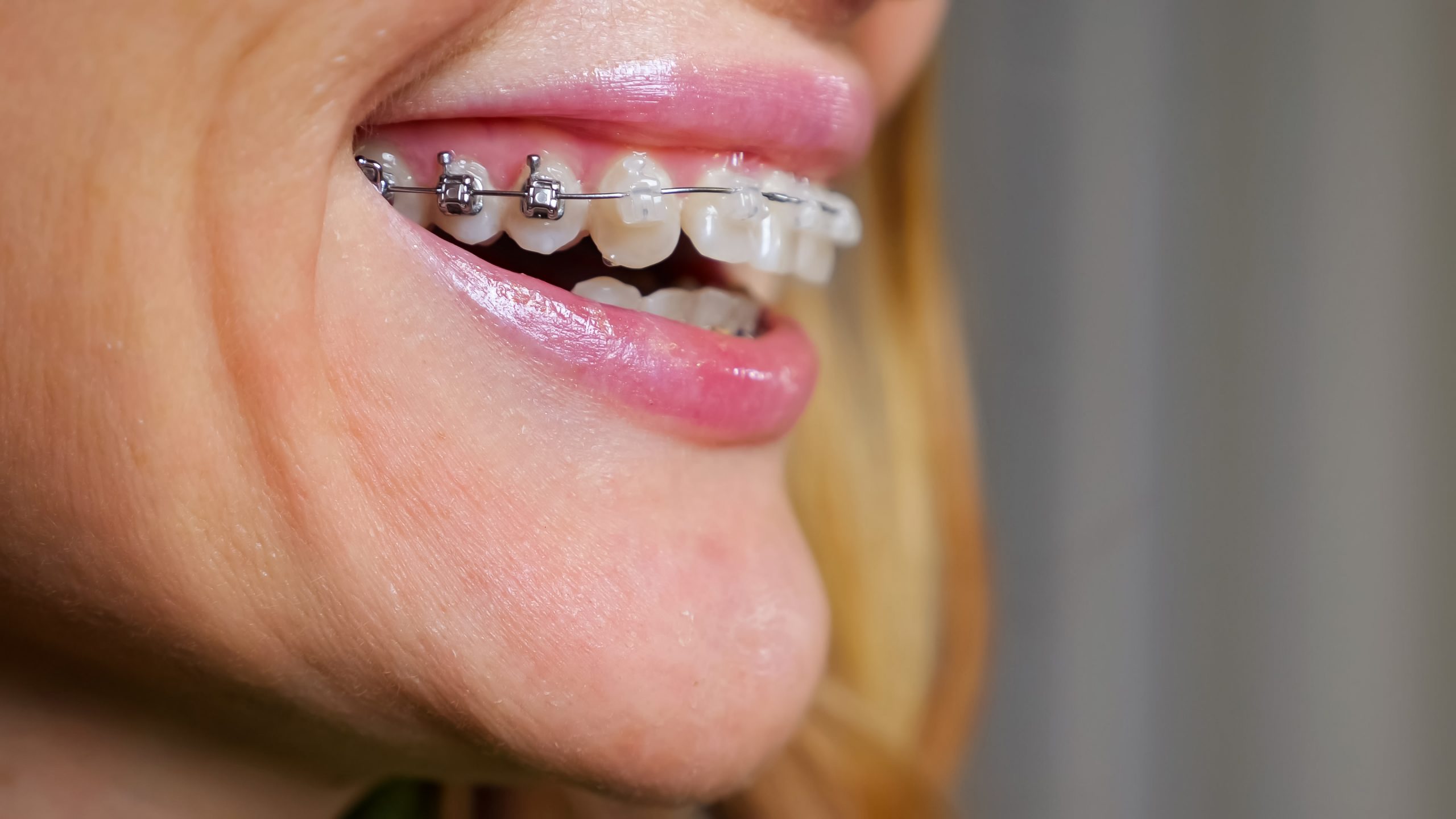 Adult patient with fixed braces, smiling
