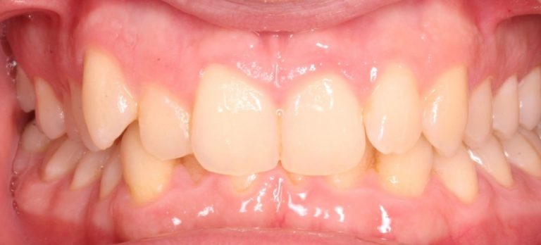 Traumatic deep bite / overbite in a child