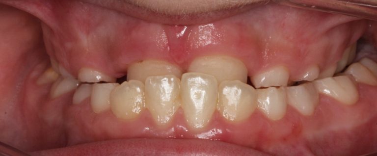 Crowding and lack of space in children’s teeth