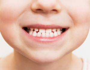 Child with braces during orthodontic treatment