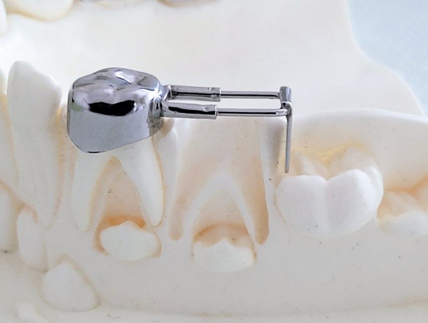 Fixed space maintainer after early loss of primary teeth